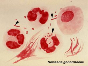 Neisseria-gonorrhoeae